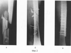 Способ лечения оскольчатых переломов (патент 2243738)