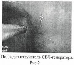 Способ термической деструкции новообразований в полых внутренних органах (патент 2455920)