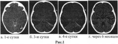 Способ прогнозирования исхода тяжелой черепно-мозговой травмы (патент 2558472)