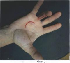 Способ лечения ятрогенной сгибательной контрактуры пальца кисти (патент 2482799)