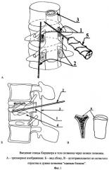 Способ переднего транспедикулярного спондилодеза (патент 2331378)
