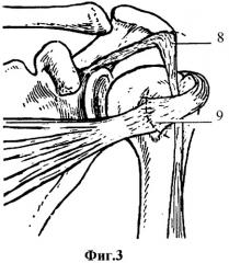 Способ оперативного лечения застарелого вывиха головки плечевой кости (патент 2321361)