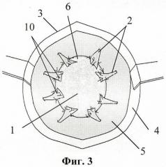 Способ пластики при больших послеоперационных вентральных грыжах (патент 2458640)