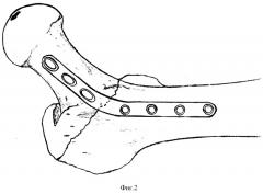 Пластина для остеосинтеза чрезвертельных переломов бедренной кости (патент 2293537)