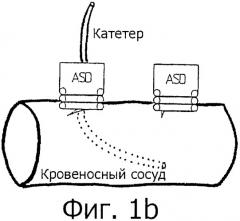 Хирургическое ввинчиваемое устройство (патент 2359715)