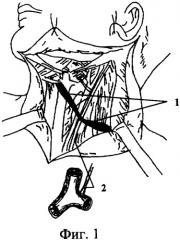 Способ профилактики лимфореи при травматических операциях в надключичной области слева (патент 2328985)