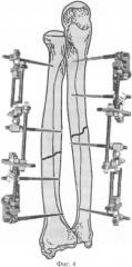 Способ чрескостного остеосинтеза диафизарных повреждений костей предплечья и аппарат для его осуществления (патент 2328242)