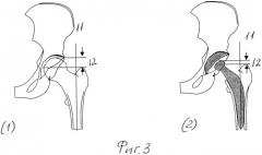 Способ рентгенологического определения относительных изменений длины конечности на уровне тазобедренного сустава (патент 2500351)