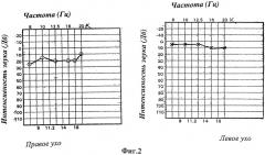 Способ диагностики ретрокохлеарных и центральных слуховых нарушений (патент 2402266)