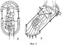 Устройство для вправления вывихов переднего отдела стопы (патент 2372881)