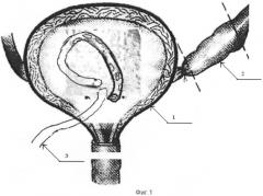Способ пересадки мочеточника (патент 2415649)