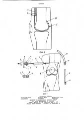Способ профилактики послеоперационных контрактур (патент 1175451)