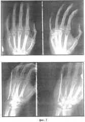 Способ лечения перелома v пястной кости кисти (патент 2555391)