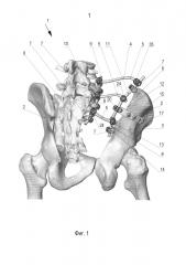Устройство для реконструкции костей таза (патент 2626122)