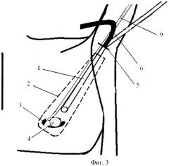 Эндоскопический способ лечения доброкачественных новообразований молочных желез у мужчин (патент 2393784)