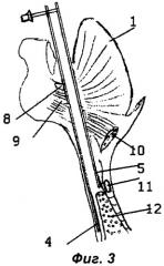 Способ операции на щитовидной железе и других органах переднего отдела шеи и ранорасширитель для ее выполнения (патент 2430686)