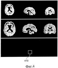 Средства диагностики нейродегенеративных заболеваний (патент 2494669)