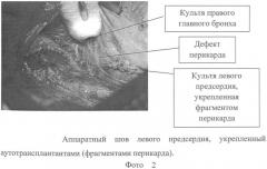 Способ аппаратного ушивания культи левого предсердия с использованием ауто- или аллотрансплантатов (патент 2466683)