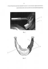 Способ реконструкции нижней челюсти аллогенным трансплантатом с одномоментной дентальной имплантацией (варианты) (патент 2595087)