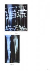 Способ замещения посттравматического дефекта большеберцовой кости (патент 2626146)