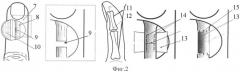 Реконструктивный способ восстановления сухожилия (варианты) (патент 2331381)