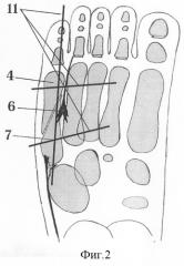 Способ реконструкции стопы у детей с удвоением пятого луча (патент 2295309)