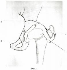 Способ выполнения транспозиции вертлужной впадины в ходе двойной остеотомии таза (патент 2474393)