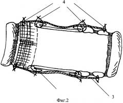 Способ замещения циркулярных дефектов трахеи (патент 2445008)