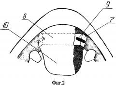 Способ формирования фронтального отдела верхней челюсти, верхней губы, преддверия полости рта и твердого неба (патент 2303413)