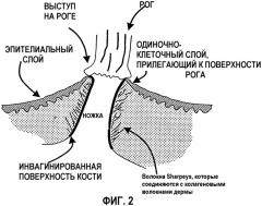 Чрескожный протез (патент 2288673)