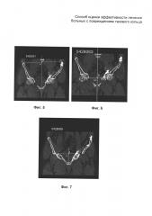 Способ оценки эффективности лечения больных с повреждением тазового кольца (патент 2600221)