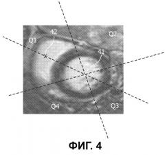 Автоматическая трехмерная сегментация изображения сердца по короткой оси, полученного методом магнитно-резонансной томографии с отложенным контрастированием (патент 2503061)