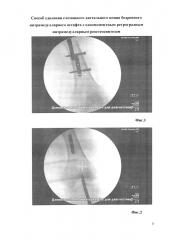 Способ удаления сломанного дистального конца бедренного блокируемого интрамедуллярного штифта с одномоментным ретроградным интрамедуллярным реостеосинтезом (патент 2653268)