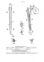 Эндопротез проксимального конца бедренной кости (патент 1340572)