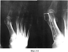 Способ определения наклона суставной поверхности головки первой плюсневой кости стопы (патент 2567825)
