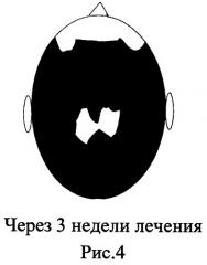 Метод лечения андрогенной алопеции: местное нанесение на очаги облысения гепарина (в составе препаратов для местного лечения) (патент 2517087)