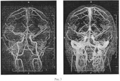 Способ контрастированной магнитно-резонансной ангиографии сосудов головного мозга (патент 2546092)