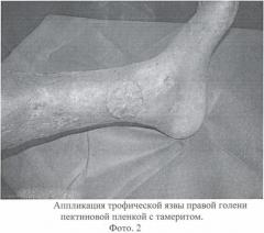 Способ лечения раневых поверхностей (патент 2360678)