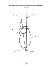 Способ измерения ротации тел позвонков у детей с идиопатическим сколиозом (патент 2587035)