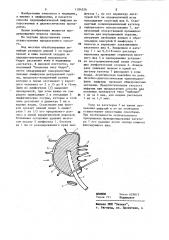 Способ антеградной эндолимфатической инфузии (патент 1184526)