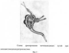 Способ цекоцистоасцендоуретропластики при экстрофии клоаки (патент 2400154)