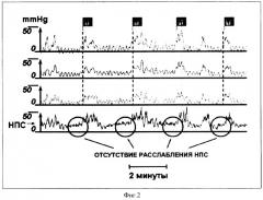 Способ диагностики моторных нарушений пищевода (патент 2339303)