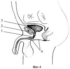 Искусственный уретральный сфинктер и способ хирургического лечения недержания мочи у мужчин (патент 2275883)