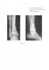 Способ открытой репозиции и остеосинтеза переломов дистального отдела костей голени (патент 2623298)