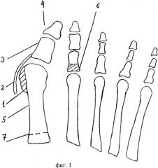 Способ оперативного лечения вальгусного отклонения первого пальца стопы ii-iv степени и молоткообразной деформации второго пальца (патент 2257174)