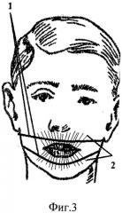 Способ и устройство для наложения лигатур при шинировании переломов челюстей (патент 2526666)