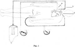 Способ унилатеральной перфузии головного мозга при операциях на дуге аорты (патент 2570286)