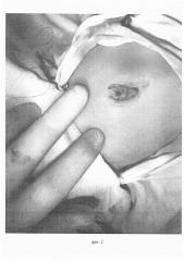 Способ выполнения неполного циркулярного параумбиликального доступа у новорожденных и детей раннего грудного возраста (патент 2633289)