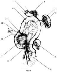 Способ тонкокишечной гастропластики после гастрэктомии (патент 2262896)