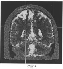 Способ определения устойчивости головного мозга к гипоксии (патент 2314747)